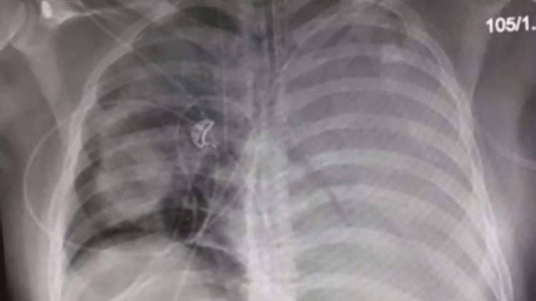 I got hit by a bacteria - My story of Legionnaires disease